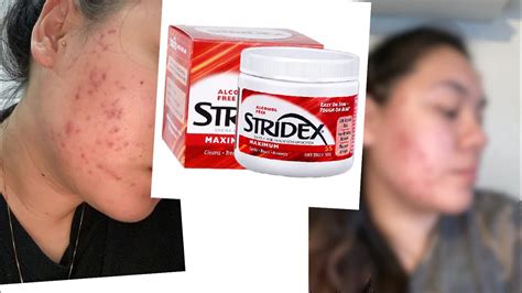 ONE MONTH USING STRIDEX PADS FOR MY ACNE - YouTube