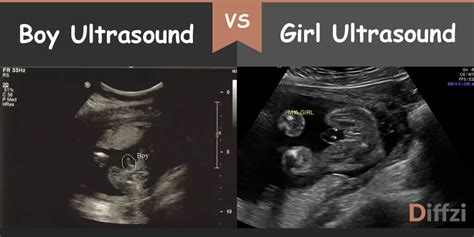 Ultrasonography Vs Ultrasound