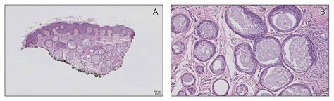 Syringoma Histology