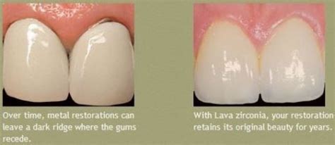 ZIRCONIA CROWNS – DENTAL IMPLANT SPECIALITY CENTRE