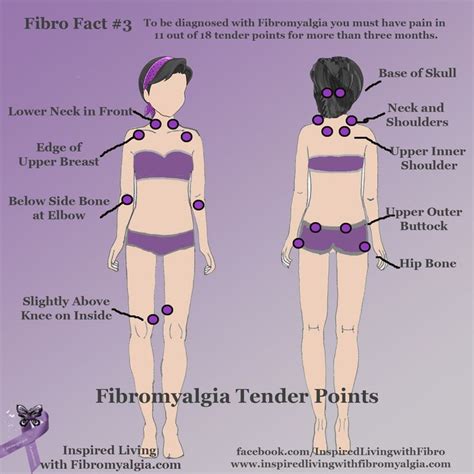 fibromyalgia trigger points - Google Search | Fibromyalgia, Fibromyalgia trigger points ...