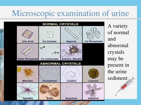 urine examination microscopically - Yahoo Image Search Results | Urinal, Medical technology ...