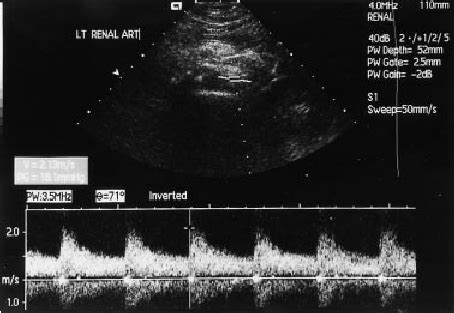 Duplex ultrasound of the left renal artery. Elevated peak systolic ...