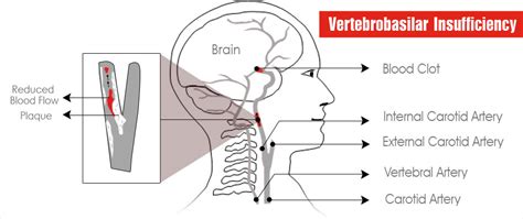 Beauty Parlor Stroke Syndrome | Vertebrobasilar Insufficiency - Causes ...