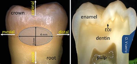 General overview of specimen showing position and extent of class V... | Download Scientific Diagram