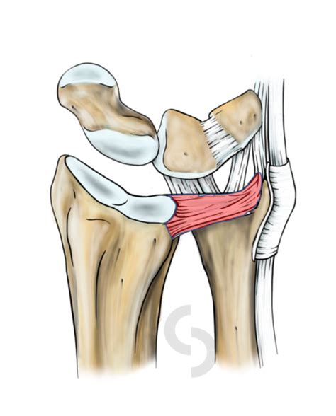 Triangular fibro-cartilage complex (TFCC) | dr Sonja Cerovac