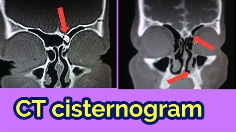 CT SCAN CISTERNOGRAM Part 1/2 - YouTube