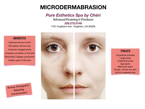 Microdermabrasion | Microdermabrasion, Microdermabrasion treatment ...