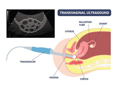 TVS Ultrasound - Transvaginal Scan Test Cost | Motherhood Fertility and IVF Centers