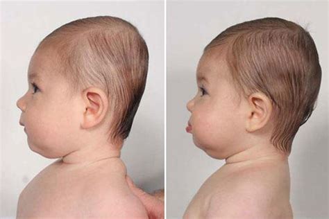 The Ins and Outs of Flat Head Syndrome in Babies