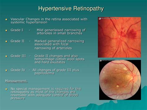 Hypertensive Retinopathy Symptoms Stages Treatment Causes Image | My XXX Hot Girl