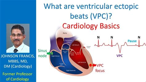 What are ventricular ectopic beats (VPC)? Cardiology Basics - YouTube