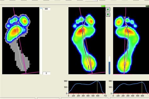 Gait Analysis | Yorkshire Sports Podiatry