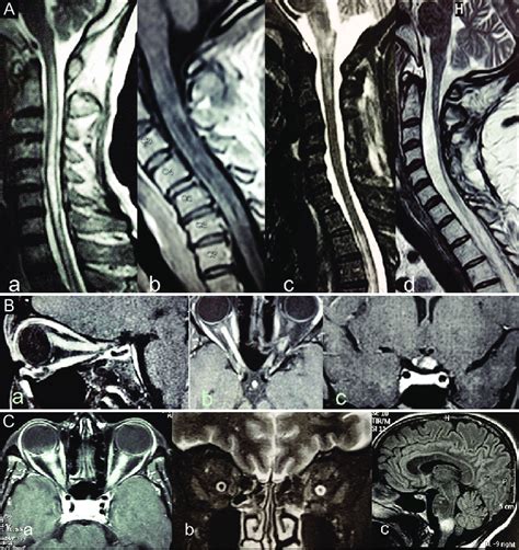 (A) Longitudinally extensive spinal cord lesions detected by MRI in ...