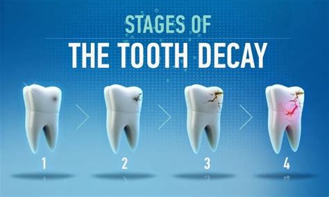 Tooth Decay Stages | Dental Dentist