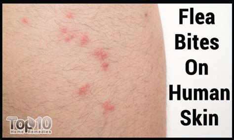 How to Treat Flea Bites on Humans and Pets | Top 10 Home Remedies