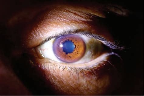 What Caused This Man's 'Scalloped' Pupil? | Live Science