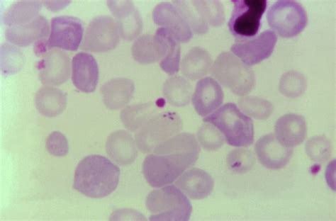 FDA Approves Blood Screens for Tickborne Parasite - Infectious Disease Advisor