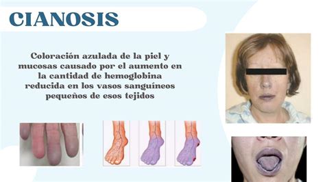 Cianosis | Ana Fernanda Zhindon Macas | uDocz