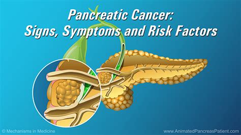 Animation - Pancreatic Cancer - Signs, Symptoms and Risk Factors