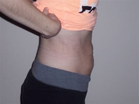 AMAZING HERNIA REVERSAL and Diastasis Recti Repair during 4 week ...