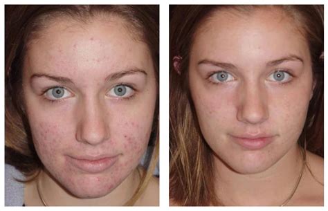 Laser Treatment For Acne and Acne Scarring | Complexions Med Spa