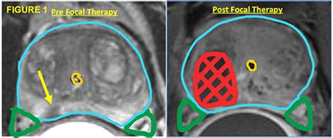 Focal Therapy: A Novel Approach for Prostate Cancer Management