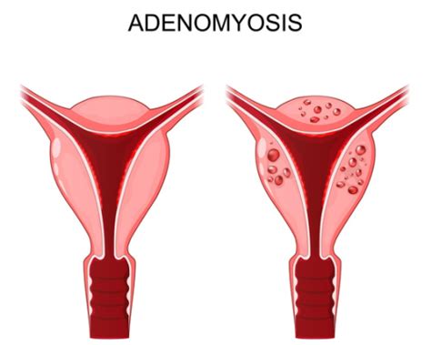 What Causes A Enlarged Uterus