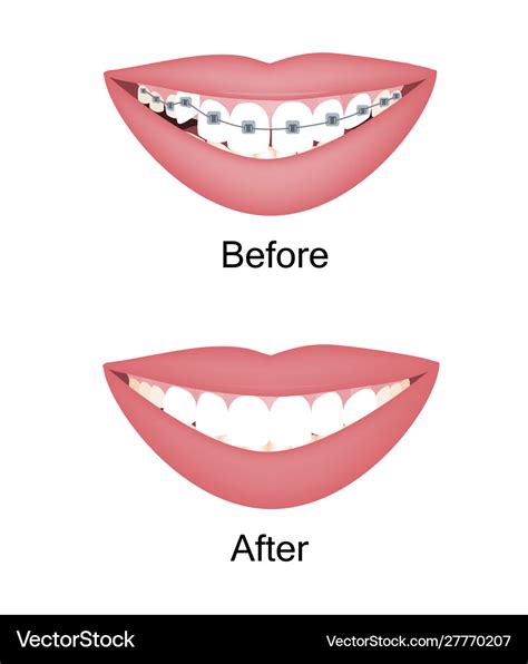 Crooked woman teeth before and after Royalty Free Vector