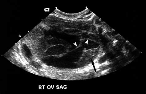 Sonographic Spectrum of Hemorrhagic Ovarian Cysts - Jain - 2002 ...