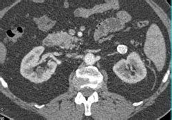 Renal Artery Aneurysm - Kidney Case Studies - CTisus CT Scanning