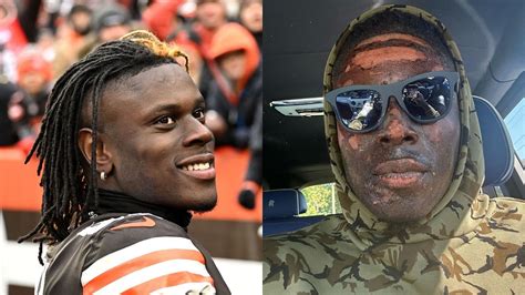 How did David Njoku burn his face? Browns star shows extent of facial burns, NFL fans laud bravery