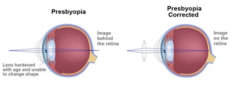 Presbyopia Red Bank | Intraocular Lens Little Silver | Atlantic Laser