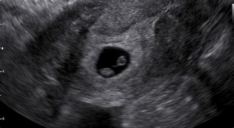 6 week scan dating