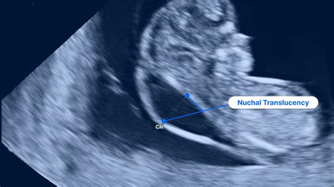 accuracy of dating ultrasound at 11 weeks