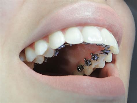 aparelho dentário invisível