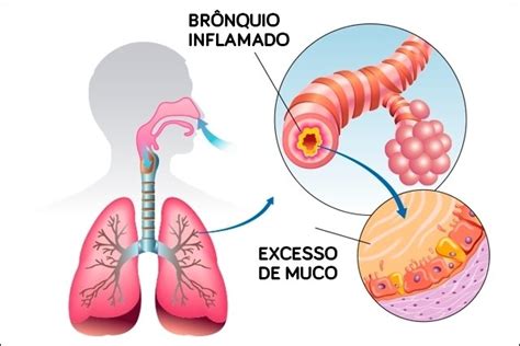 bronquite
