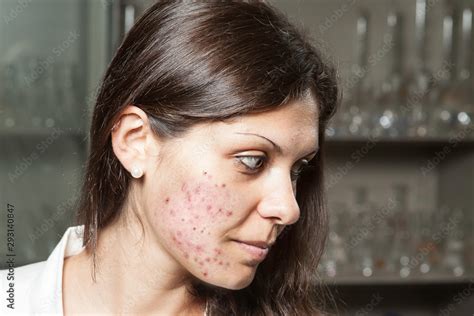 dating a girl with bad skin