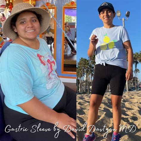 dating after bariatric surgery