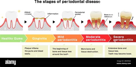 dating periodontitis