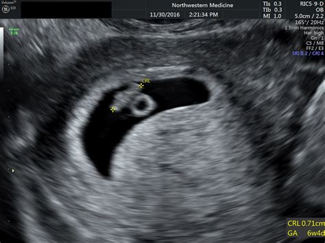 dating scan 6 weeks heartbeat