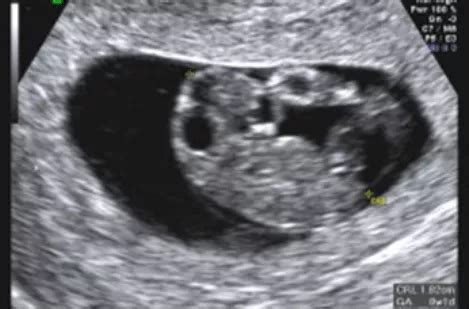 dating scan accuracy 11 weeks
