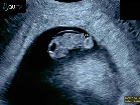 dating scan crl