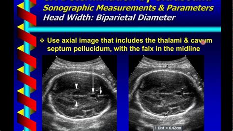 dating ultrasound measuring behind