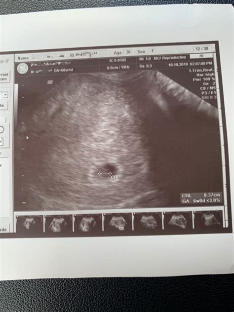 dating ultrasound no heartbeat
