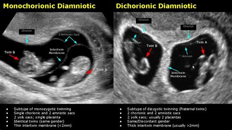 dating ultrasound twins