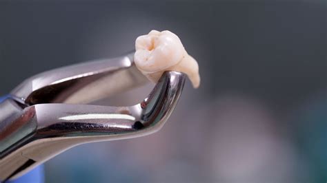exodontia de dente