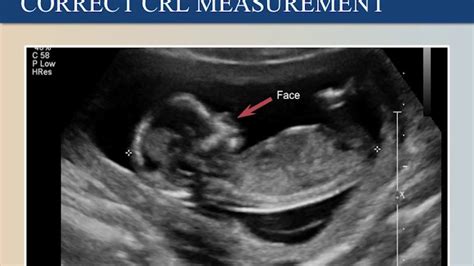 how accurate are dating ultrasounds