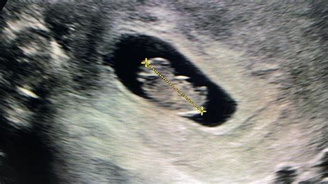 how accurate is 8 week dating scan