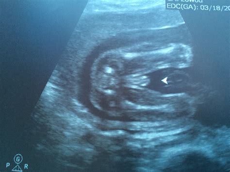 how accurate is 9 week dating scan